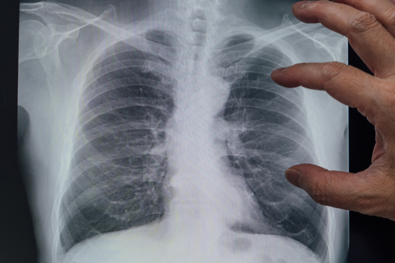 吸菸對身體的危害諸多，如發炎、癌症等，圖為一名吸菸者的X光片，因長期吸菸而出現肺阻塞（COPD）問題。（攝影／余志偉）