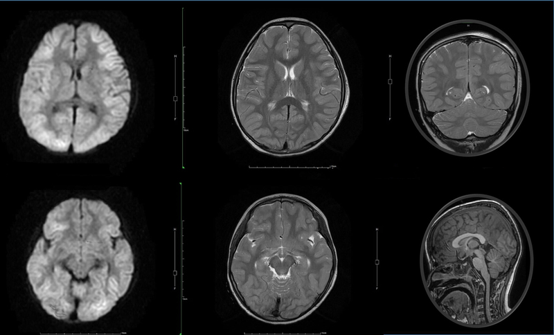Omicron引發腦炎案例的兒童腦部核磁共振影像。（圖片提供／台大醫院雲林分院）